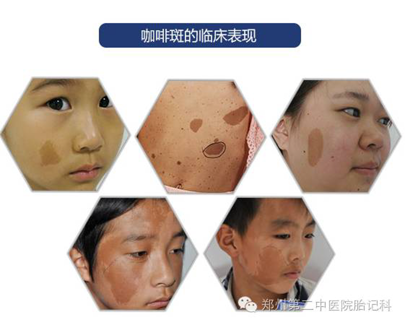 胎记治疗新进展:让美丽与健康同行!