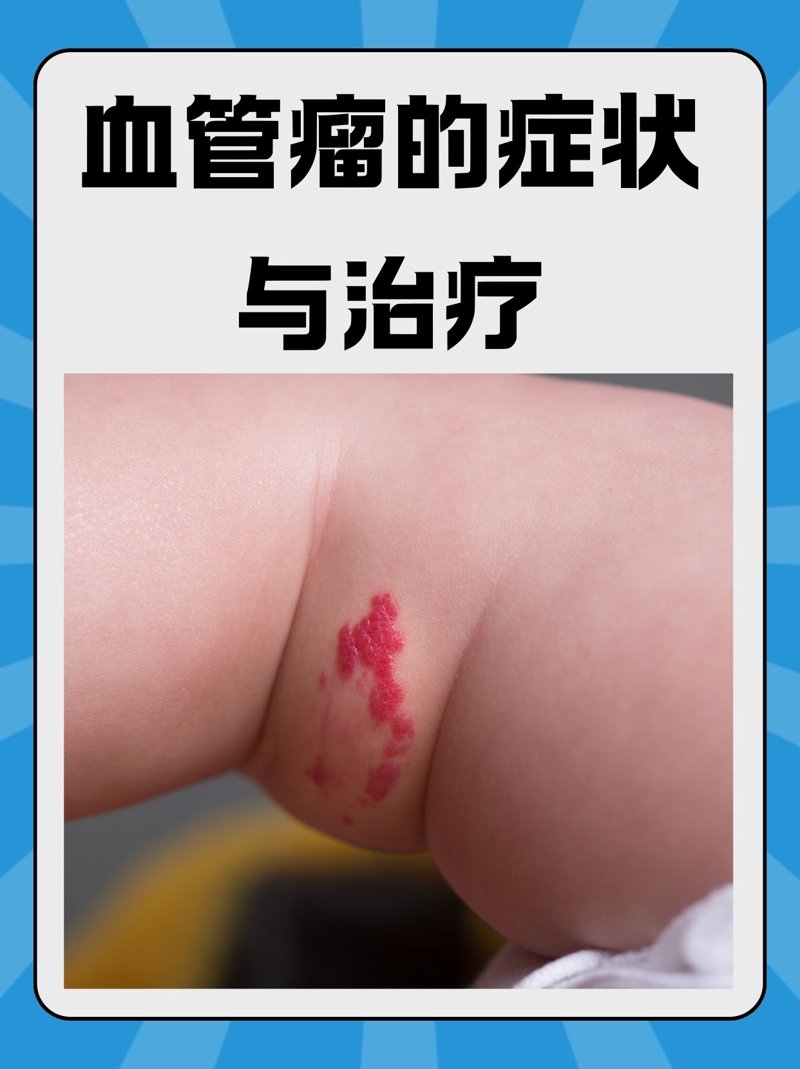 太田痣治疗:医学前沿与护理进阶