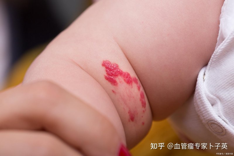 血管瘤治疗