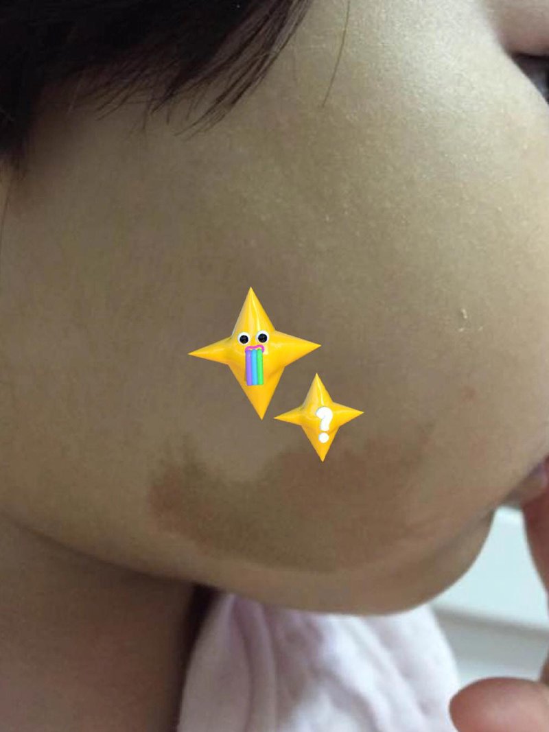 胎记治疗:选择广州的专业医院