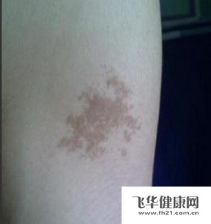 广州胎记医院:破解肌肤难题的新篇章