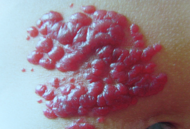 草莓状血管瘤图片