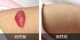 广州健肤血管瘤治疗前后图片